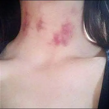 Las marcas de la adolescente de 15 años fueron descubiertas por otros maestros de su establecimiento educativo.