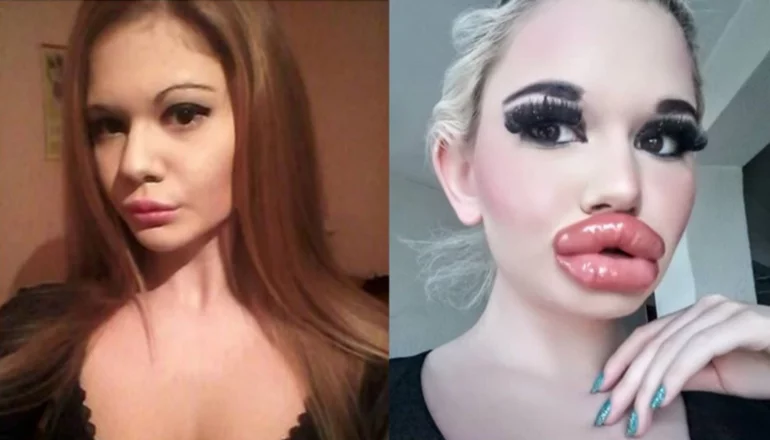 La mujer con los labios más grandes del mundo, Andrea Ivanova, quiere seguir aumentándolos
