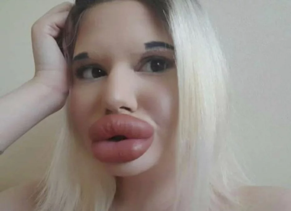 Mujer con los labios más grandes del mundo seguirá aumentándoselos