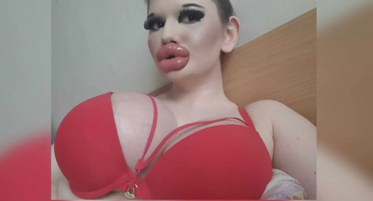 Mujer con los labios más grandes del mundo seguirá aumentándoselos