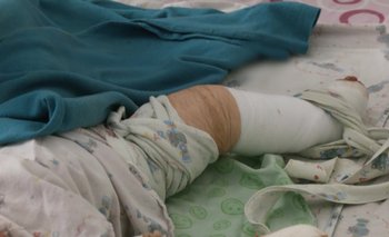 A poco del alta: La bebé quemada en Tiquipaya ya recibió injertos de piel