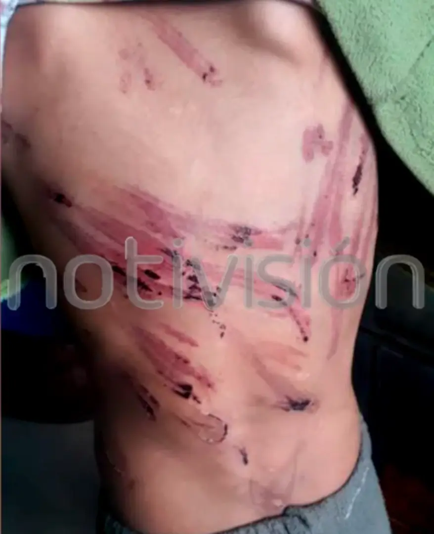 Las lesiones en la espalda del niño.