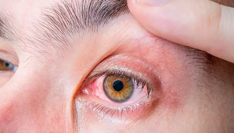 Cochabamba registró 98 casos de conjuntivitis por la contaminación ambiental. Imagen referencial RR.SS.