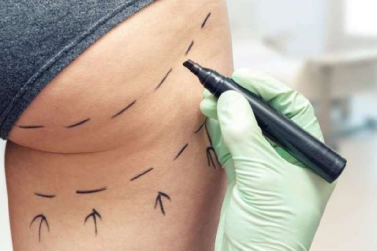 Implantes caseros deformaron los glúteos de una mujer Implantes caseros deformaron los glúteos de una mujer